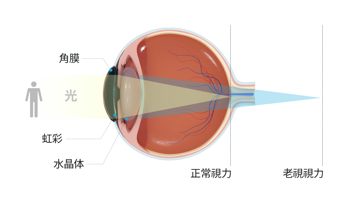 Presbyopia